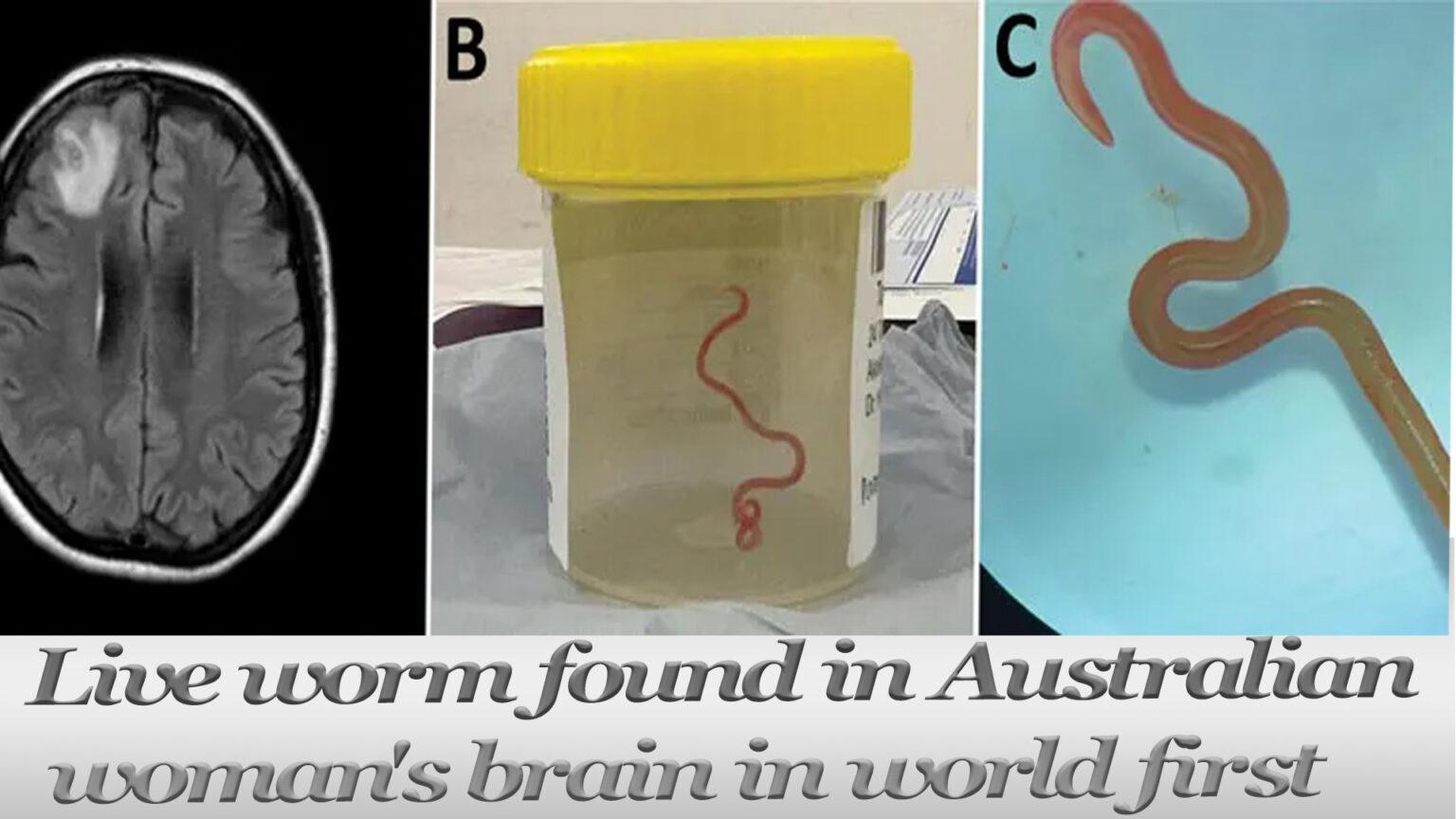 World's First: 8-Cm Parasite Surgically Removed from Woman's Brain